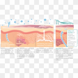 Silagen Strips, HD Png Download