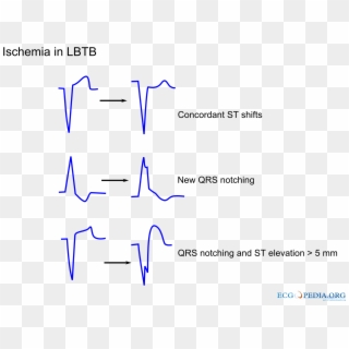 Mi Lbbb - Difference Between Ischemia And Infarction Ecg, HD Png Download