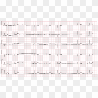 Conduction Ecg - First Degree Av Block Sinus Bradycardia, HD Png Download