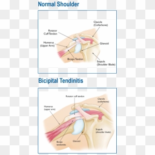 Biceps Normal V Tendinitismelissa Fitzgerald2018 09 - Shoulder Anatomy, HD Png Download