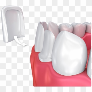 Porcelain Veneers - Dental Veneers Png, Transparent Png