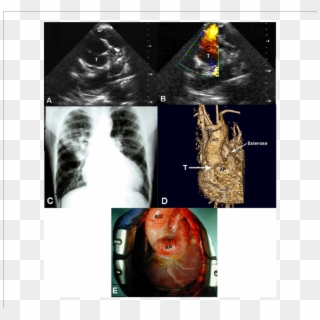-a) Ecocardiograma Demonstrando Artéria Pulmonar Emergindo - Radiology, HD Png Download