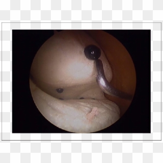 Arthroscopic View From Within The Simulator Of A Subject - Cymbal, HD Png Download