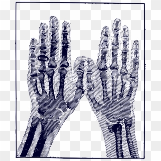 Bones Hand Image Medical Medicine Picture Ring - X Ray Hand Png Vector Free Illustrator, Transparent Png
