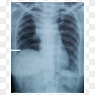 Chest X Ray Showing Elevated Right Hemi Diaphragm And - Elevated Right Hemidiaphragm X Ray, HD Png Download