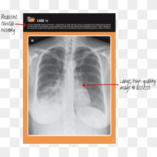 Chest X-ray Example - Radiography, HD Png Download