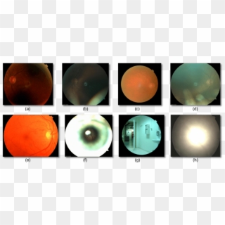 Examples Of Poor Quality Fundus Images - Poor Quality Of Fundus, HD Png Download