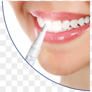 White Blitz Teeth Whitening Teeth Whitening For Spas/salons - Lifetime Teeth Whitening, HD Png Download