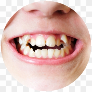 Malocclusion In Child, HD Png Download