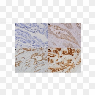 Immunostain Score Of Claudin-2 Expression In Esophageal - Art, HD Png Download