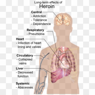 Long-term Effects Of Heroin - Long Term Effects Of Heroin, HD Png Download
