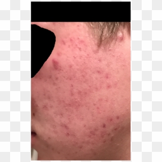 Acne Help - Close-up, HD Png Download