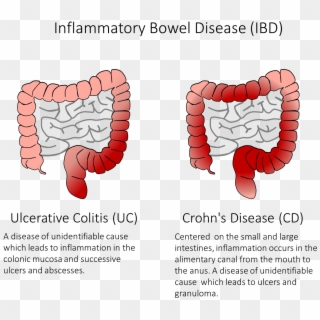Figure 1) Ibd Is A Group Of Diseases Which Cause Inflammation - Inflammatory Bowel Disease Adalah, HD Png Download
