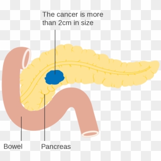 Diagram Showing Stage T2 Cancer Of The Pancreas Cruk - Pancreatic Cancer Png, Transparent Png
