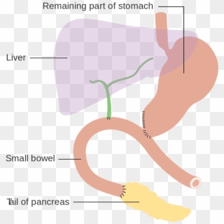 Diagram Showing How The Pancreas And Bowel Is Joined - Traverso Longmire Operation, HD Png Download