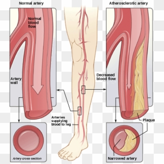 Peripheral Arterial Disease - Peripheral Artery Disease, HD Png Download
