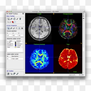 Itk Snap Is A Software Application Used To Segment - 3d Medical Image Segmentation, HD Png Download