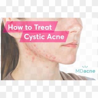 Blog Header Image For How To Treat Cystic Acne - Poster, HD Png Download