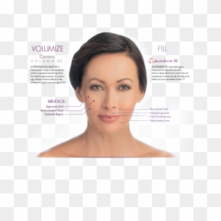 How Png Bruise Juvederm - Submalar Injections, Transparent Png