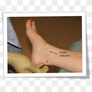 A Patient S Bare Foot And Ankle Can Be Seen Resting - Toe, HD Png Download