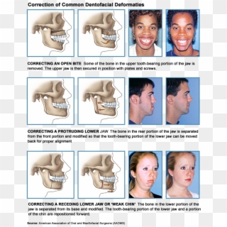 Dentofacial Orthodontic Surgery, Coquitlam, Bc - Jaw Correction Braces, HD Png Download