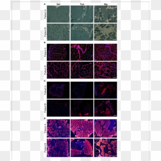 Histological Markers Of Muscle Degeneration In Torn - Illustration, HD Png Download