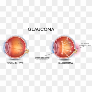 Eyesmart American Academy Of Ophthalmology - Prevent Glaucoma, HD Png Download
